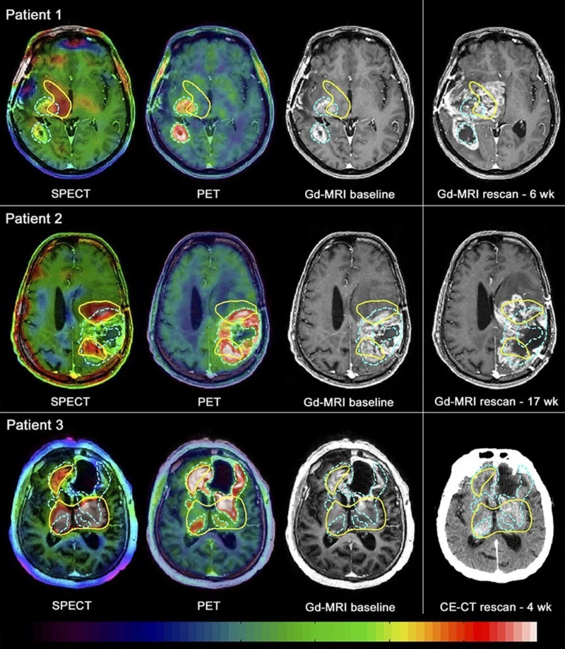 Kadınların Alzheimer'a erkeklerden daha fazla yatkın olmasına neden olan gen keşfedildi: MGMT